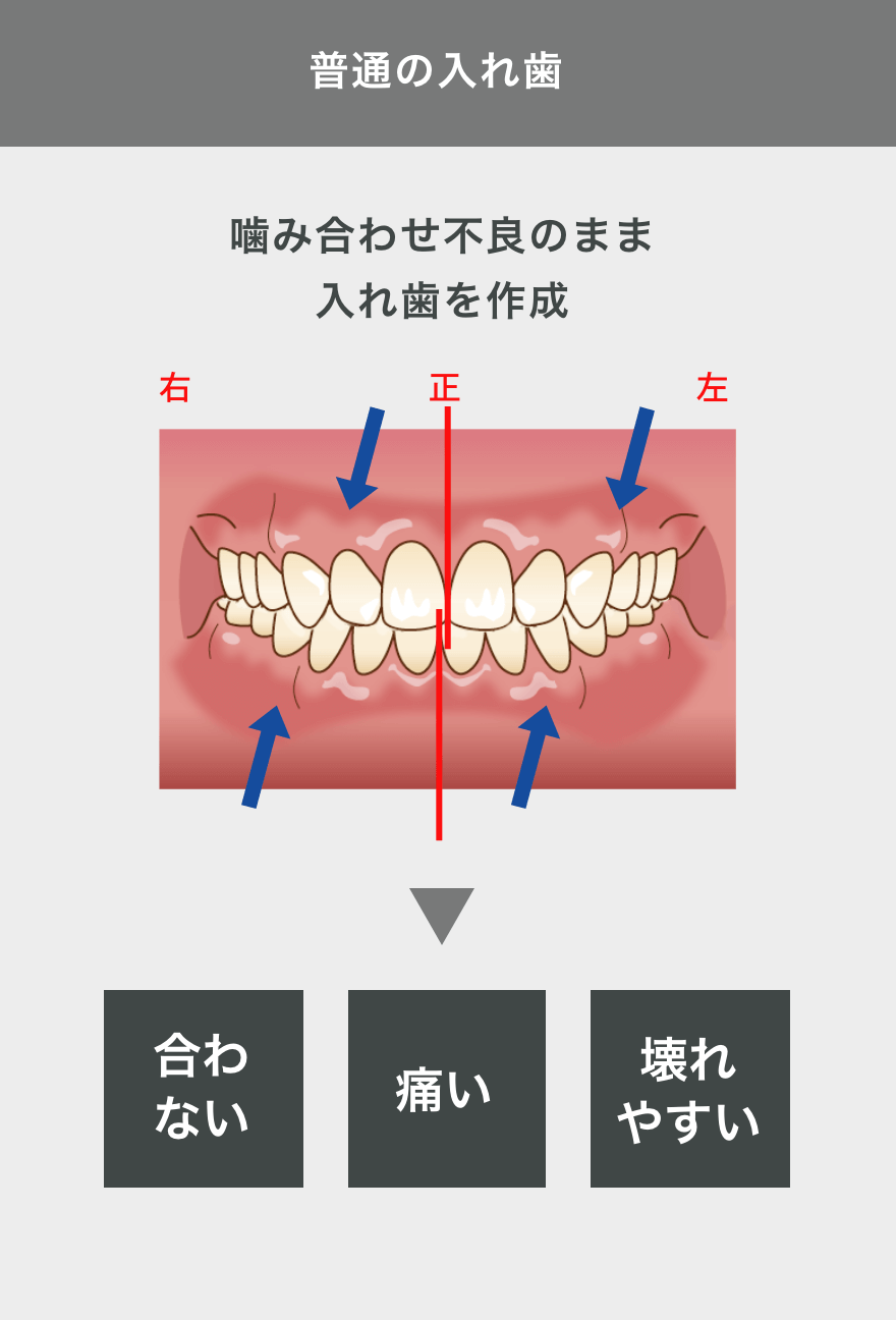 普通の入れ歯